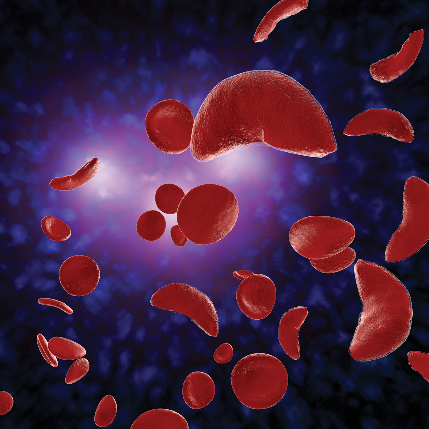 sickle-shaped blood cells